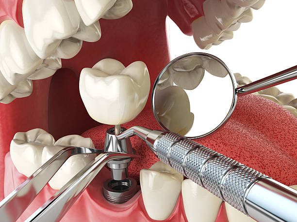 Best Emergency Root Canal Treatment in Vandalia, MO